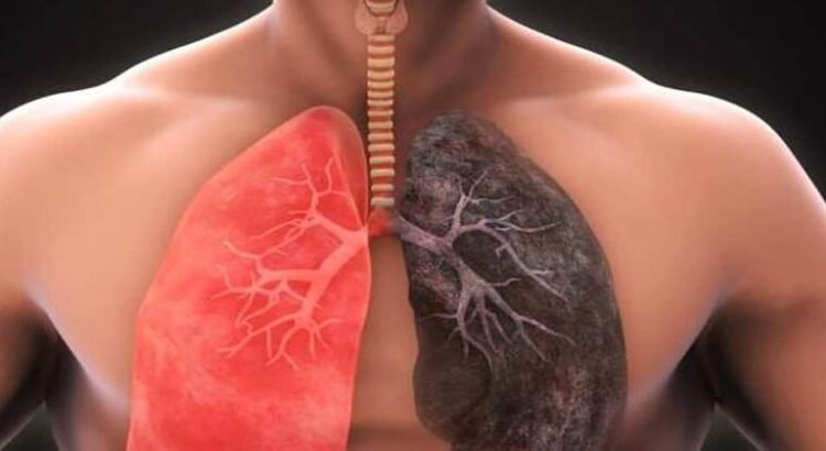 Aumentan casos de Epoc en Sonora, principalmente en Guaymas y Nogales