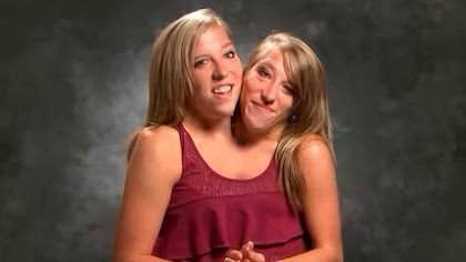 Gemelas Abby y Brittany Hensel generan rumores tras ser vistas con un bebé en Minnesota